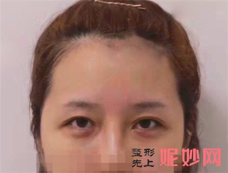 来看看在北京东方百合医疗美容门诊部找王世勇做的眼部修复真人案例分享