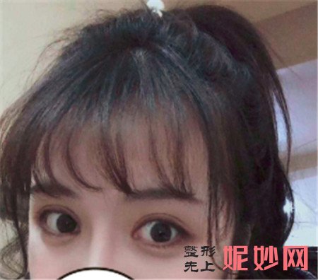 来看看在北京东方百合医疗美容门诊部找王世勇做的眼部修复真人案例分享