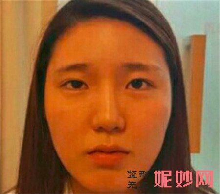北京黛美的弯鹏飞医生做激光溶脂瘦脸怎么样？真人案例分享