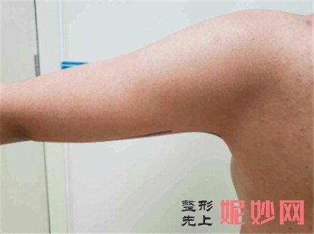 在北京黛美医疗美容诊所找弯鹏飞做的吸脂瘦手臂怎么样？案例效果图展示