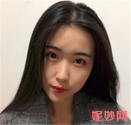 来看看北京黛美医疗美容诊所弯鹏飞自体脂肪面部填充的真人案例对比图分享！