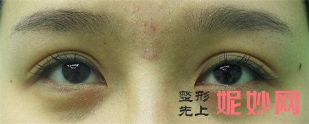 到北京百达丽医疗美容门诊部找苏婷做的眼部修复，术后两个月眼睛有神不少