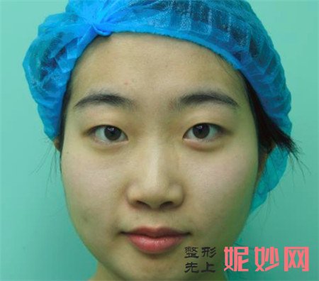 到北京百达丽找苏婷医生做的埋线双眼皮怎么样？真人案例分享