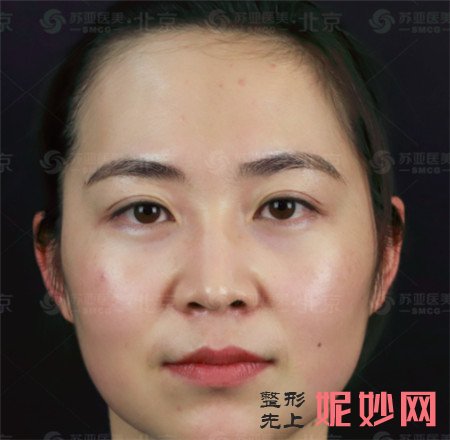 到北京苏亚医疗美容医院找隋冰医生做的埋线提升怎么样？真人案例分享