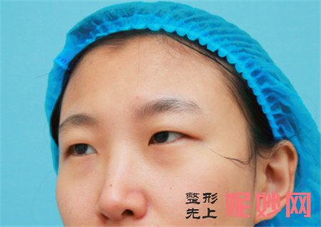 北京延世医疗美容诊所的宋俊岭做眼部多项的技术怎么样？真人案例分享