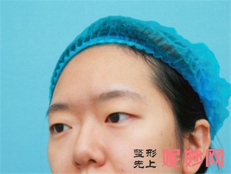 到北京延世找宋俊岭做的切开双眼皮，术后90天恢复后眼睛好看很多