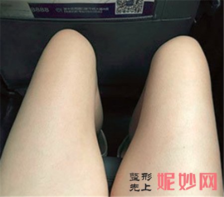 到北京紫洁俪方找刘文峰做的大腿吸脂怎么样？术后两个月真人案例分享