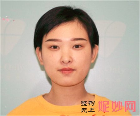 到北京丹熙找罗汇东做的面部吸脂，术后70天塑造小V脸
