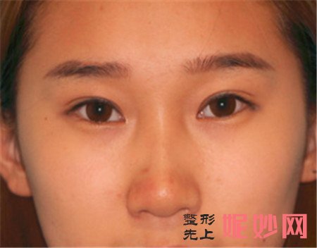 在北京唯颜时代找马永奇做的线雕隆鼻怎么样？真人案例分享