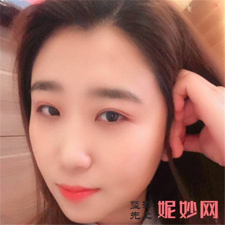 到北京惠合嘉美找陈旭做的除皱瘦脸，术后92天脸颊线条感十足