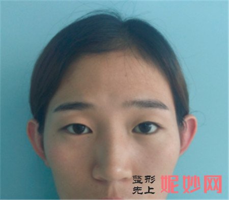 在清华大学玉泉医院找刘静杰做双眼皮怎么样？眼部多项真人案例分享