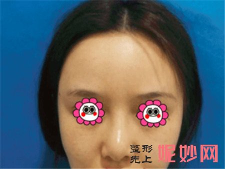 到北京彤美找李长赋医生做的肋软骨隆鼻，术后三个月鼻子精致又好看