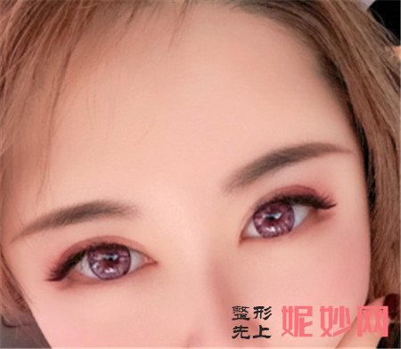 在北京薇琳找李鹏超做的双眼皮效果怎么样？切开双眼皮案例对比图展示