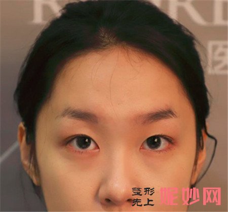 到北京薇琳找李鹏超做的鼻部多项怎么样？真人案例分享