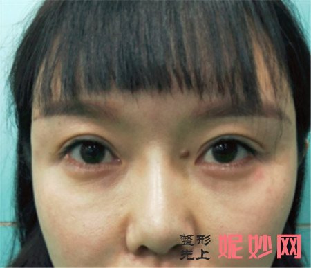 在北京蕾士悦找李海兵做的鼻部修复怎么样？术后100天鼻子变得很自然