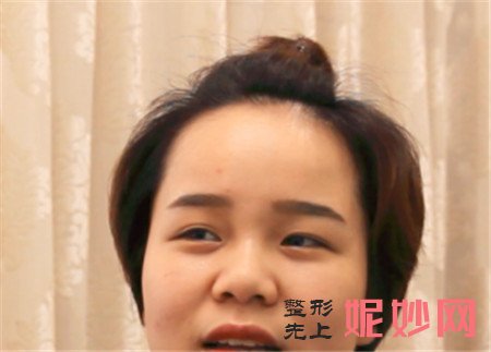 来看看北京艾玛的丁小邦做的隆鼻手术效果怎么样？鼻部多项案例分享