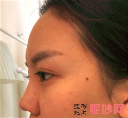 在北京韩啸找姜辉做的耳软骨复合隆鼻，术后120天鼻子恢复得很好