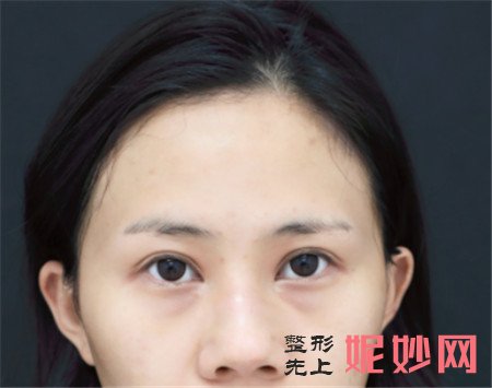 北京卓新华星的姬广翰做的硅胶隆鼻怎么样？真人案例效果图展示
