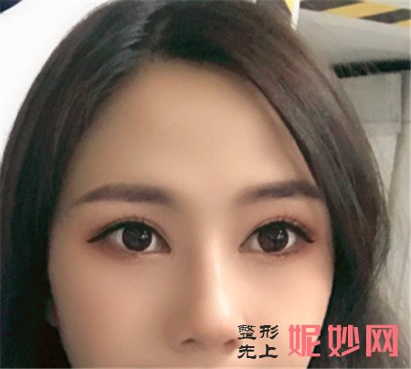 北京卓新华星的姬广翰做的硅胶隆鼻怎么样？真人案例效果图展示