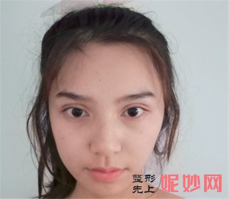 到北京卓新华星找姬广翰做的面部吸脂，术后90天脸蛋变得小巧又紧致
