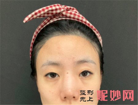 北京卓新华星的姬广翰做硅胶隆鼻的效果怎么样？真人案例对比图分享