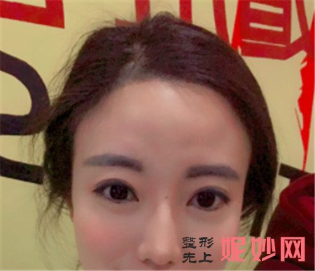 北京卓新华星的姬广翰做硅胶隆鼻的效果怎么样？真人案例对比图分享