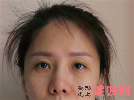 到北京凯润婷找胡彬做的隆鼻手术怎么样？术后120天案例对比图展示