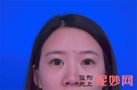 北京凯润婷的胡彬做的肋软骨隆鼻怎么样？术后三个月案例效果展示