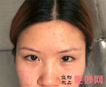到北京凯润婷找胡彬做的隆鼻效果怎么样？硅胶隆鼻案例术后三个月分享