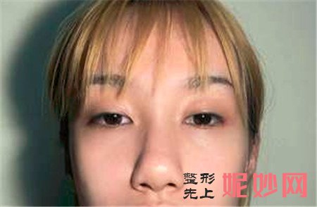 北京叶子的洪春医生做的硅胶隆鼻怎么样？真人案例分享