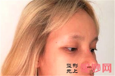 北京叶子的洪春医生做的肋软骨隆鼻怎么样？真人案例对比图分享