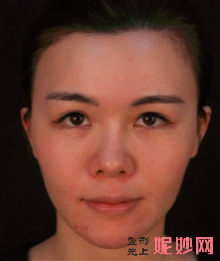 到北京薇琳找韩楚做的埋线提升，术后四个月的脸饱满紧致了好多