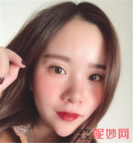 在北京艺美找巩敏做面部吸脂的效果怎么样？术后三个月对比图展示