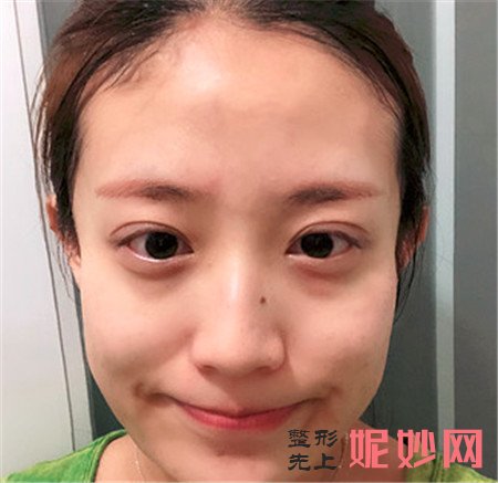 到北京京城皮肤医院找管乐做的面部提升怎么样？案例效果对比图分享