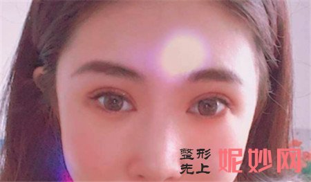 到北京庆熙找冯邦化做的双眼皮修复怎么样？真人案例对比图分享