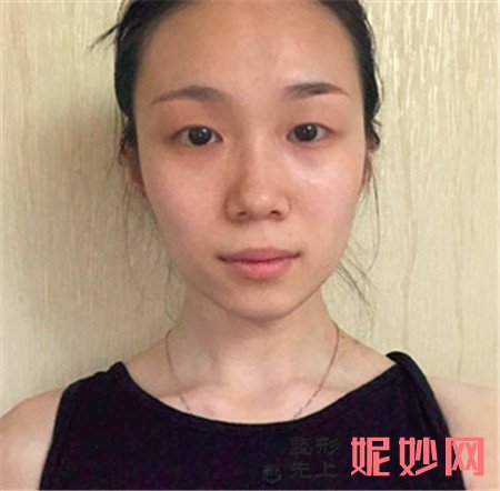 北京庆熙的冯邦化做的双眼皮效果怎么样？切开双眼皮真人案例分享