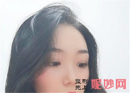 北京庆熙的冯邦化做的双眼皮效果怎么样？切开双眼皮真人案例分享