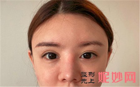 到北京柏丽找冯振科做的鼻子怎么样？真人案例术后三个月效果图展示