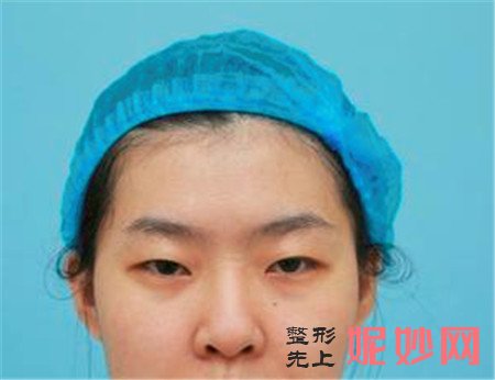 来看看北京延世的金奇龙全切双眼皮的真人案例分享！
