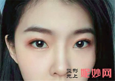 来看看北京延世的金奇龙全切双眼皮的真人案例分享！