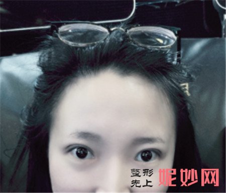 到北京凯润婷找段九梅做的双眼皮怎么样？真人案例对比图展示