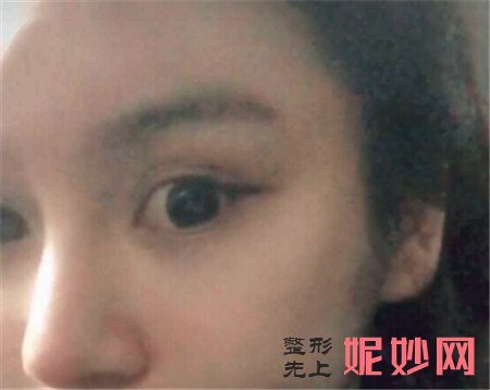 北京莫琳娜的李辉隆鼻的技术怎么样？鼻部综合真人案例分享