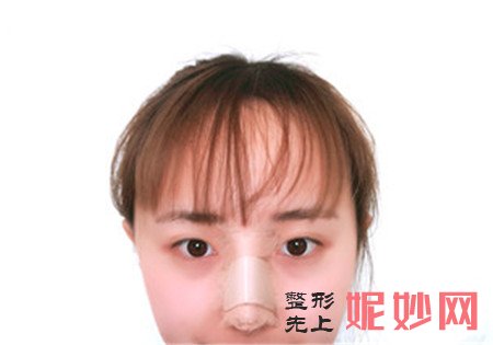 在北京唯颜时代找周辉做的鼻部综合怎么样？术后78天恢复效果展示