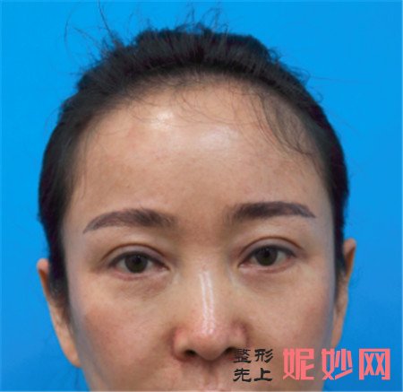 到北京加减美找黄寅守医生做的埋线提升，术后120天脸型和气质都改变了
