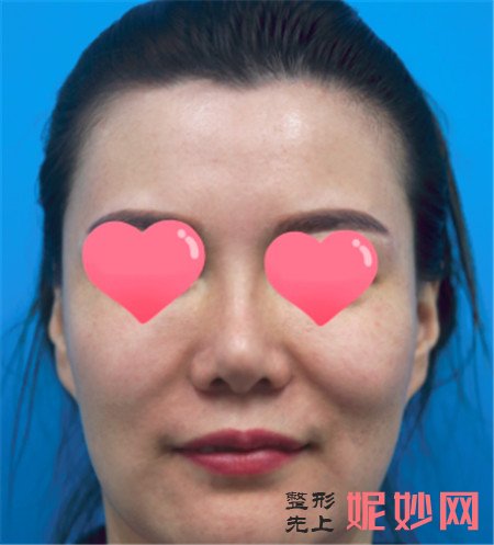 北京加减美照穆宝安医生做的埋线提升，术后三个月拥有了巴掌鹅蛋脸