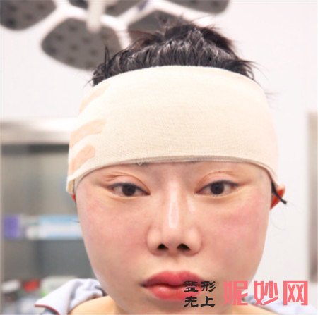 在北京彤美找潘彦龙医生做的埋线提升，术后90天脸“嘭”起来了