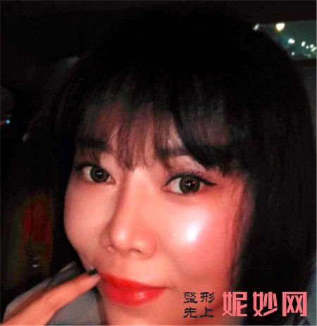 在北京彤美找潘彦龙医生做的埋线提升，术后90天脸“嘭”起来了