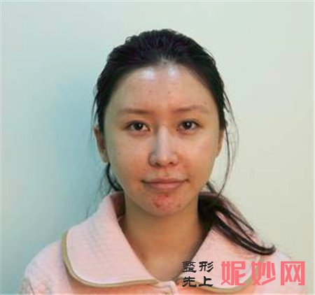 找北京中西医结合医院的胡守舵医生做的面部吸脂手术，终于拥有小V脸