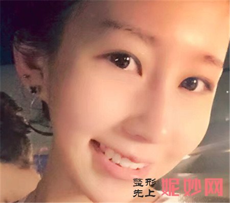 找北京中西医结合医院的胡守舵医生做的面部吸脂手术，终于拥有小V脸