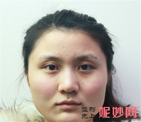 找上海时光的何晋龙做的V-LINE瓜子脸手术，术后110天告别“大方脸”~